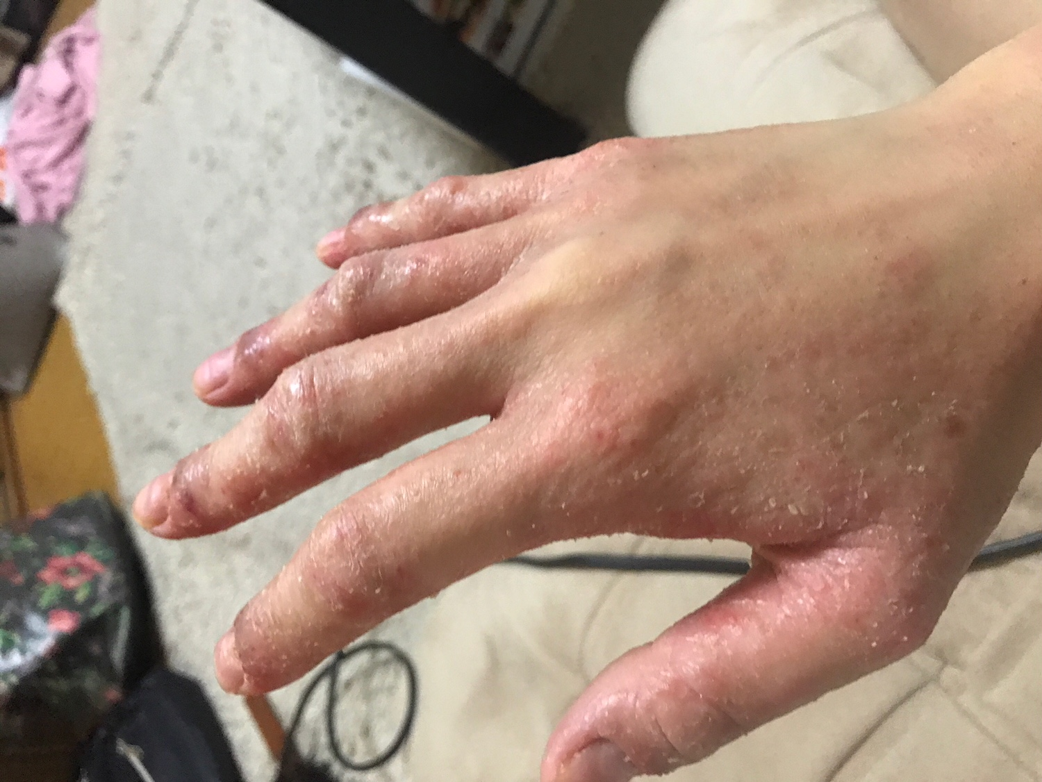 施術１回の手の皮膚のアレルギー症状の写真